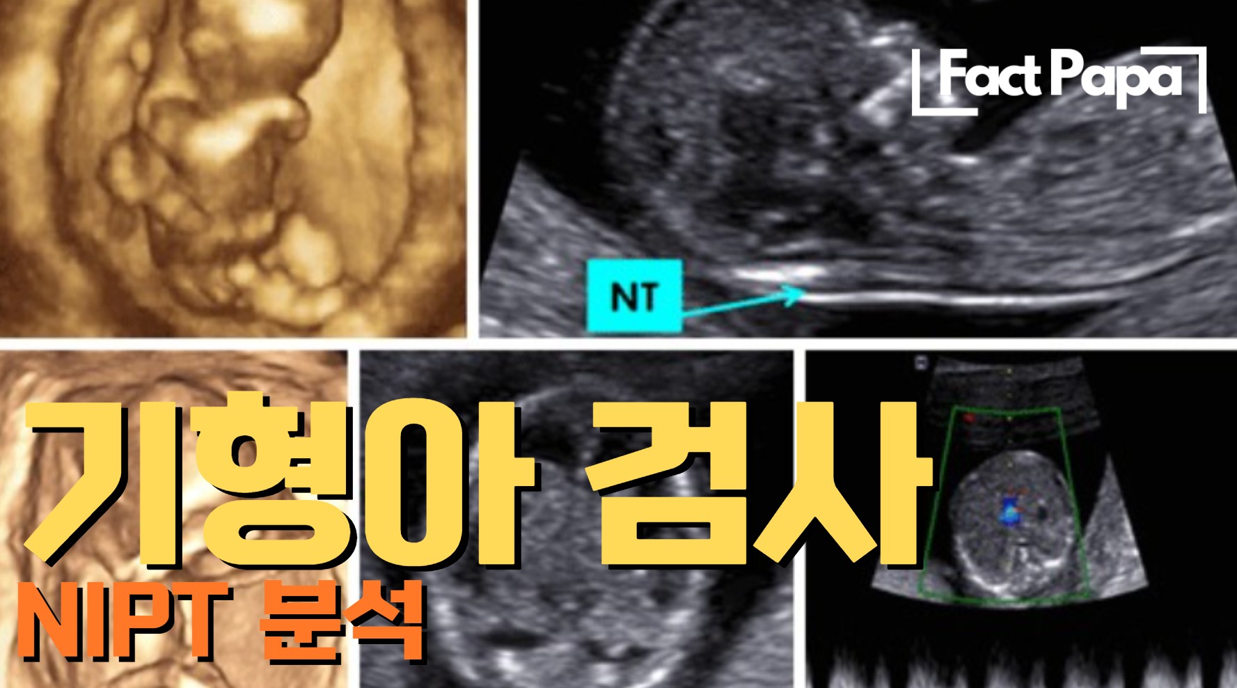 태아 초음파 사진과 NT(목덜미 투명대) 측정 화면이 포함된 기형아 검사 및 NIPT 분석 가이드 썸네일 이미지
